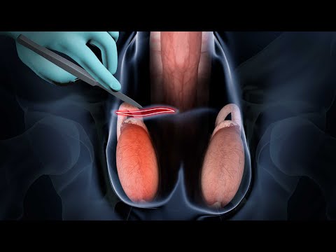 Vasectomy step by step
