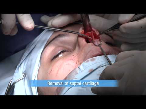 Rhinoplasty