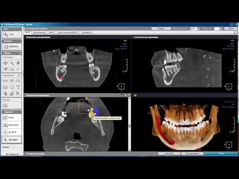 Обзор программы Ondemand3d Dental