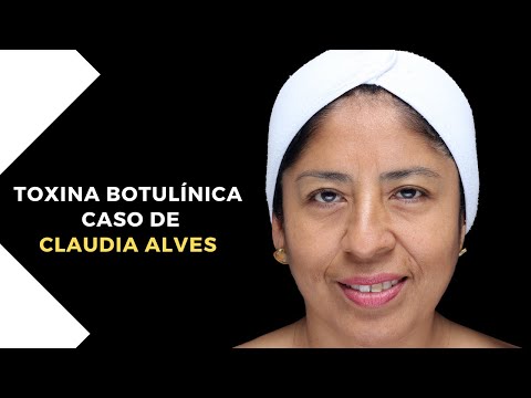 Caso de CLAUDIA : Toxina botulínica