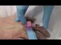 Cannulation- How to gain IV access