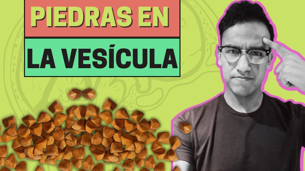 PIEDRAS EN LA VESÍCULA: síntomas, diagnóstico, tratamiento y prevención (colelitiasis)