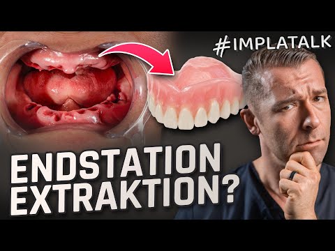 Alle Zähne ziehen?! Warum das die schlimmste Entscheidung deines Lebens sein kann!