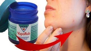 How to Use Vicks Vaporub for Pimples, Acne Scars & Facial Redness