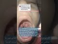 Large Tonsils Tonsillitis Tonsillectomy Baray Galon Ka Ilaj Bhokh Ka Na Lagna Galay Me Takleef