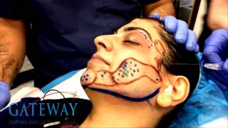 Acne Scar Subcision with Taylor Liberator