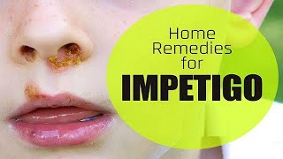 How to Get Rid of Impetigo Overnight with Home Remedies.