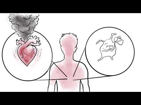 Gene Therapy for Friedreich's Ataxia