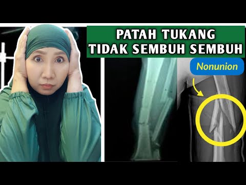 PATAH TULANG TIDAK MAU SEMBUH || Kenali penyebab dan penanganan NONUNION