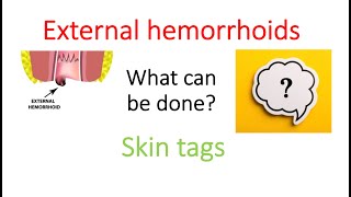 External hemorrhoids and Skin tags. What can be done?
