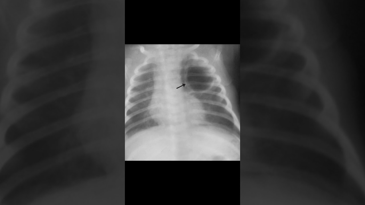 Rx de Tórax -- Abscesso Pulmonar