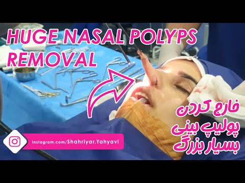 Huge Nasal Polyps Removal By Dr. Shahriyar Yahyavi