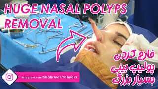 Huge Nasal Polyps Removal By Dr. Shahriyar Yahyavi