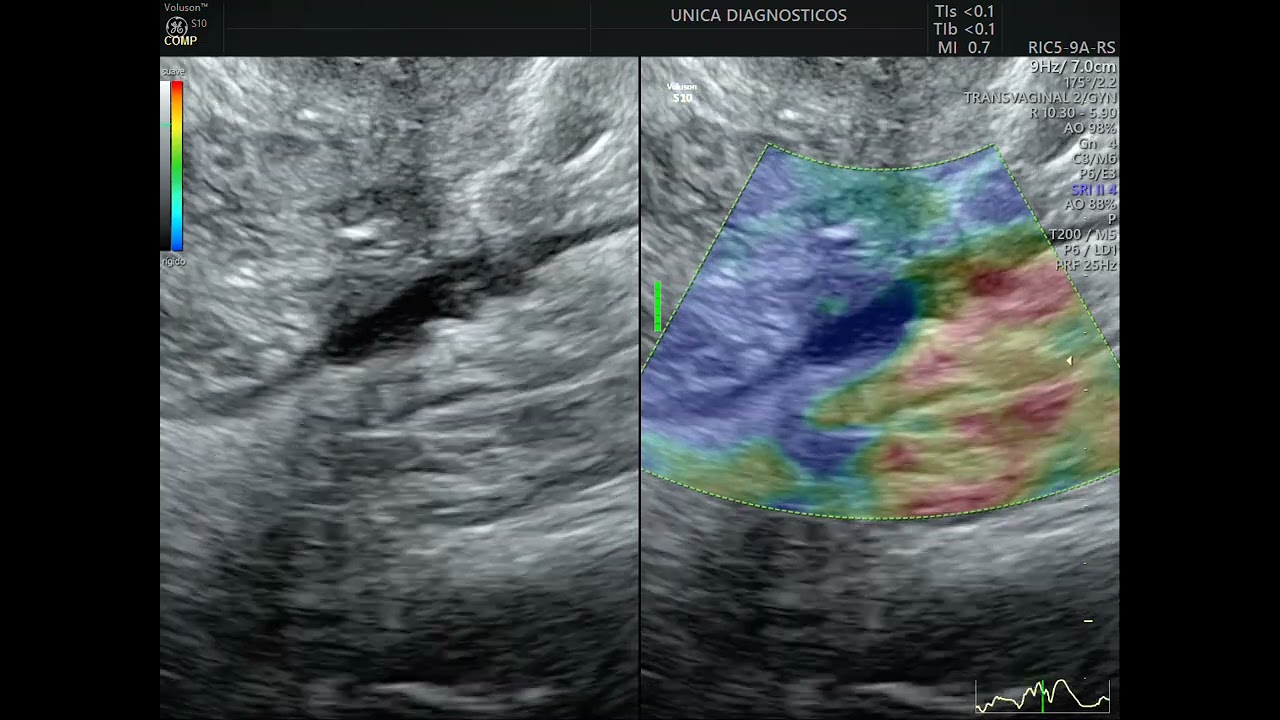 Mapeamento de endometriose intestinal