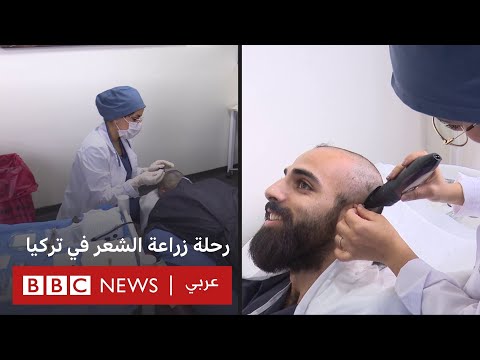 تقنيات زراعة الشعر في تركيا