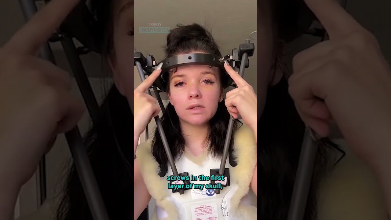 The Story Behind My Halo Brace