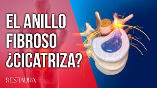 El anillo fibroso ¿cicatriza