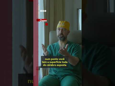 Gêmeas siamesas veem o rosto uma da outra após cirurgia inédita com IA