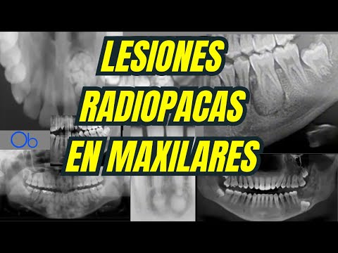Lesiones Radiopacas en Maxilares 💀🩻