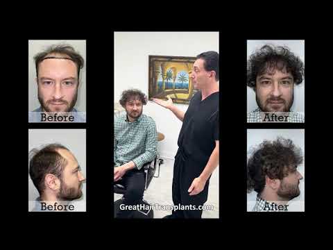 Dr. Bret Bolton Patient Mark MaxHarvest Hair Transplant Procedure