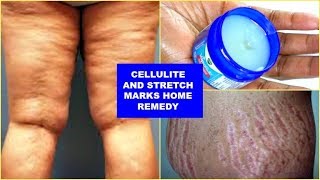 REDUCE CELLULITE AND STRETCH MARKS FAST AND EFFECTIVELY, WITH JUST 3 INGREDIENTS |Khichi Beauty