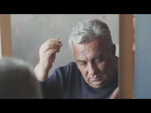 Different types of alopecia and treatment options | FOX 7 Austin