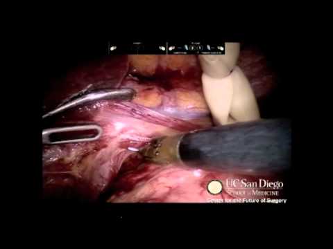 Laparoscopic Assisted Robotic Esophagectomy