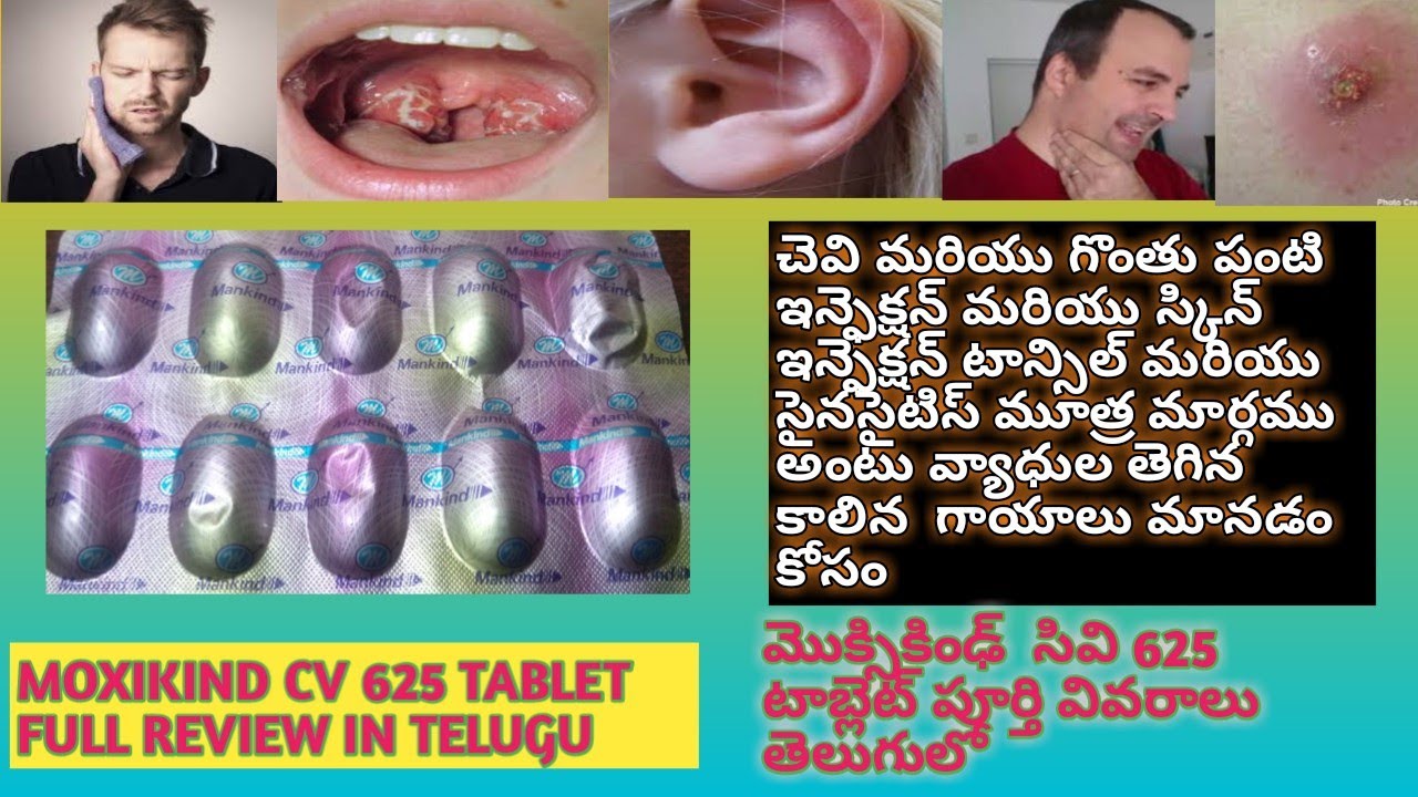 Watch video MOXIKIND CV 625 TABLET FULL REVIEW IN TELUGU AMOXICILLINE TO TREAT FOR SKIN AND BECTERIAL INFECTIONS Now MOXIKIND CV 625 TABLET FULL REVIEW IN TELUGU AMOXICILLINE TO TREAT FOR SKIN AND BECTERIAL INFECTIONS