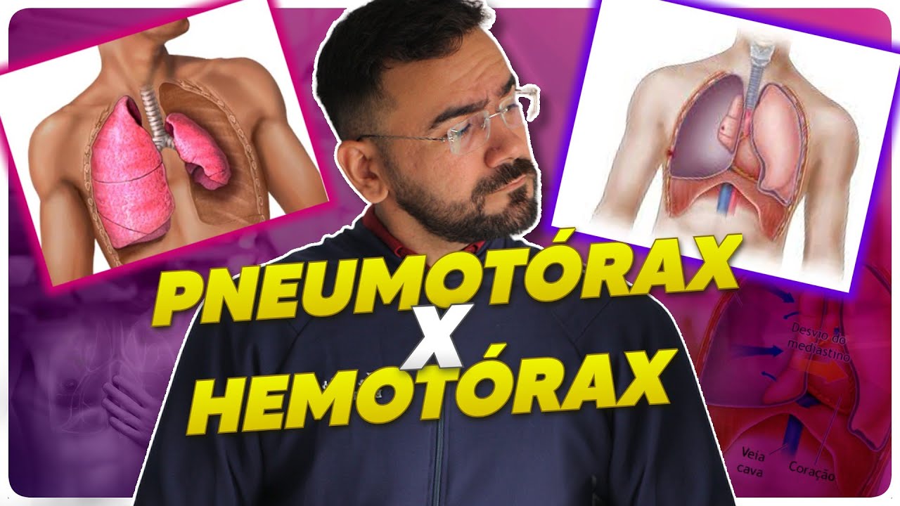 PNEUMOTÓRAX E HEMOTÓRAX: QUAL A DIFERENÇA ENTRE ELES DOIS? - URGENCIA E EMERGÊNCIA