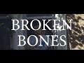 Rob Lynch - Broken Bones (Official Video)