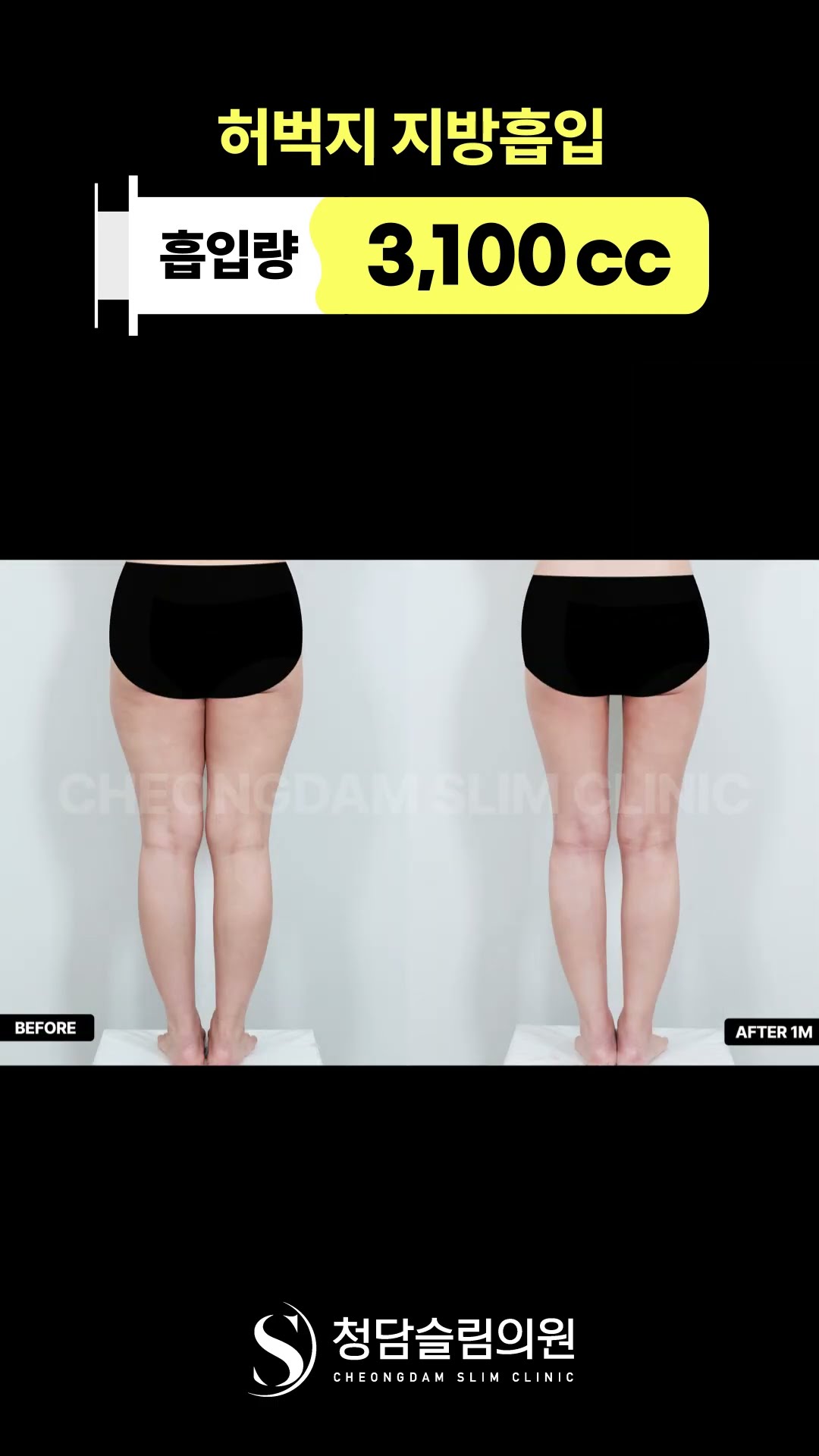 붙던 하체 라인 사라짐… 한달차 변화 👖