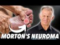 Morton's Neuroma: Absolute Best Treatment (In Our Opinion)