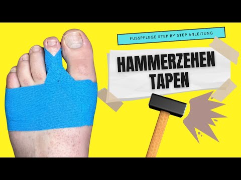 HAMMERZEH TAPEN | Hammerzehen tapen Anleitung