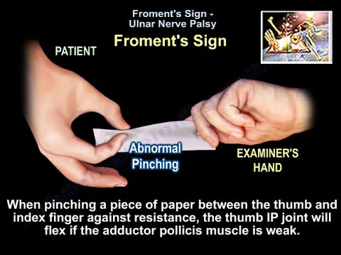 Froment-Zeichen – Alles, was Sie wissen müssen – Dr. Nabil Ebraheim