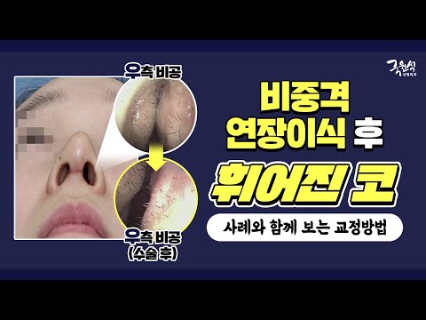 #비중격연장이식 후 코가 휘었다? (Feat. 실제 사례와 함께 보는 교정 방법)