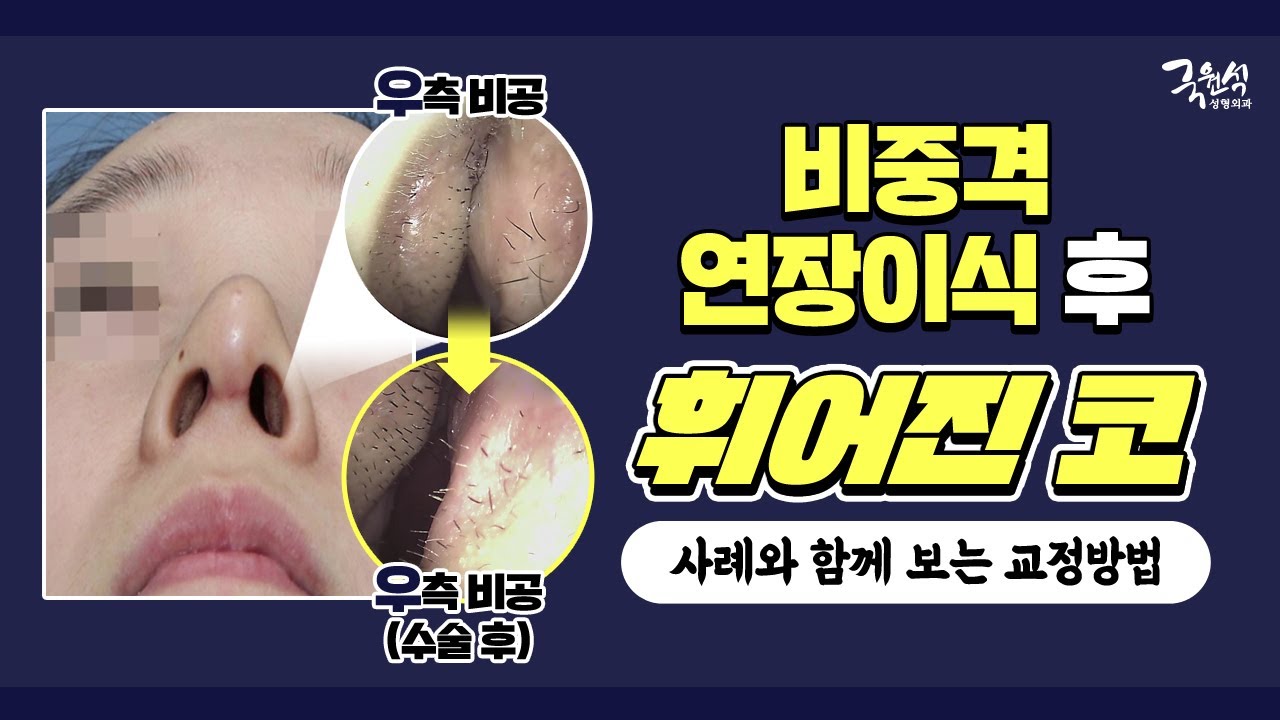 #비중격연장이식 후 코가 휘었다? (Feat. 실제 사례와 함께 보는 교정 방법)