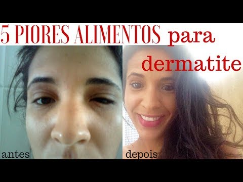 Cura di eczema secco di spazzole La psoriasi che per una malattia e da quello che appare