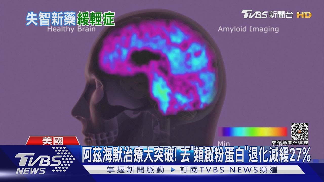阿茲海默治療大突破！　去「類澱粉蛋白」退化減緩27%