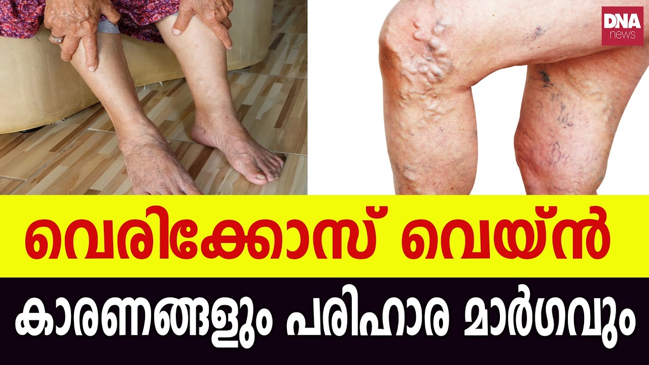 Varicose veins Varicose veins