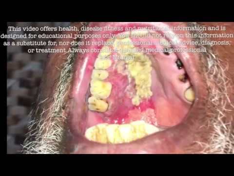 Nicotinic acid na may kuko halamang-singaw Seal toenails mga sanhi at paggamot