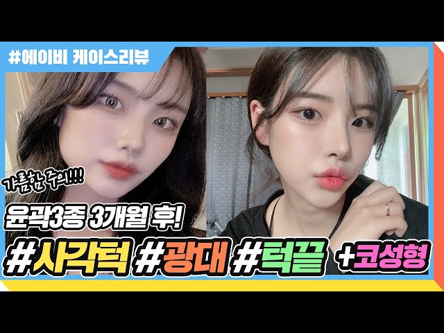 코재수술비용 합리적인 1