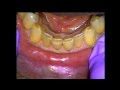 Composite restoration - Incisal Edge Reinforcement