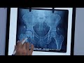 When To Go For Hip Replacement In AVN