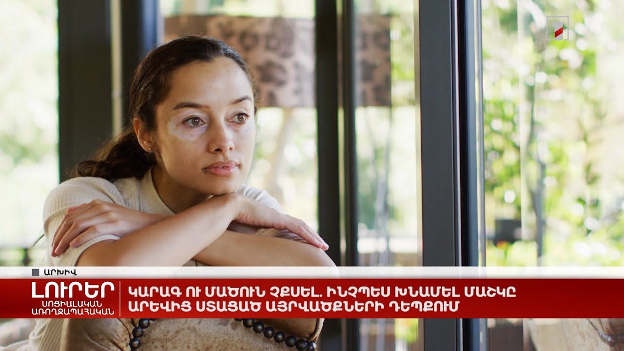 Կարագ ու մածուն չքսել․ ինչպես խնամել մաշկը արևից ստացած այրվածքներից հետո