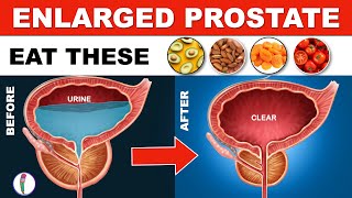 Prostate enlargement Treatment (Naturally) | Benign Prostatic Hyperplasia | Enlarged Prostate Diet