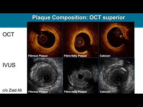 Precision PCI: The Link Between OCT Use and Lower Major Adverse Cardiac Events