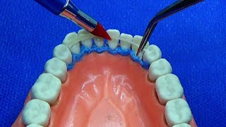 Ferulizar dientes con movilidad/ fibra de vidrio Interlig
