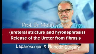 Miniaturka - Ureteral stricture and hydronephrosis  due to dense fibrosis. Metin Ertem MD FACS.