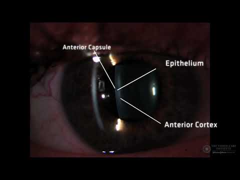 Slit Lamp Techniques   Optical Section of Crystalline Lens