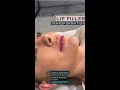 Lip Filler Transformation | Immediate Results In Just Minutes